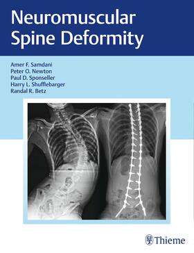 Samdani / Newton / Sponseller | Neuromuscular Spine Deformity | Buch | 978-1-62623-260-0 | sack.de