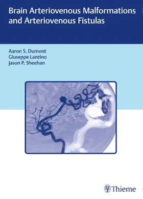 Dumont / Lanzino / Sheehan |  Brain Arteriovenous Malformations and Arteriovenous Fistulas | eBook | Sack Fachmedien