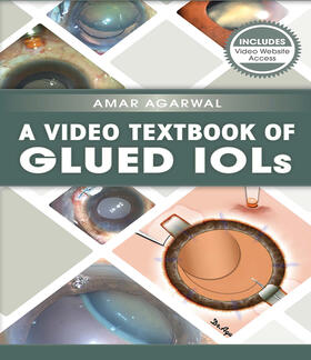 Agarwal | A Video Textbook of Glued IOLs | Buch | 978-1-63091-224-6 | sack.de