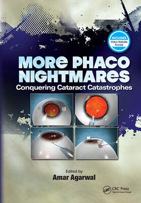 Agarwal | More Phaco Nightmares | Buch | 978-1-63091-439-4 | sack.de