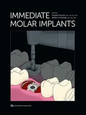 Deporter / Ketabi |  Immediate Molar Implants | eBook | Sack Fachmedien