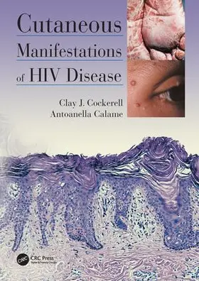 Calame / Cockerell |  Cutaneous Manifestations of HIV Disease | Buch |  Sack Fachmedien