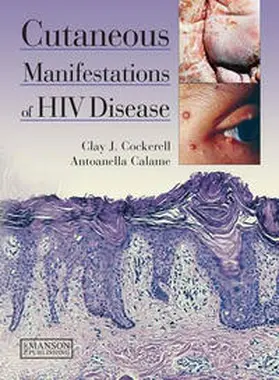 Cockerell / Calame |  Cutaneous Manifestations of HIV Disease | eBook | Sack Fachmedien