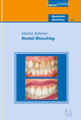 Kelleher |  Dental Bleaching | eBook | Sack Fachmedien