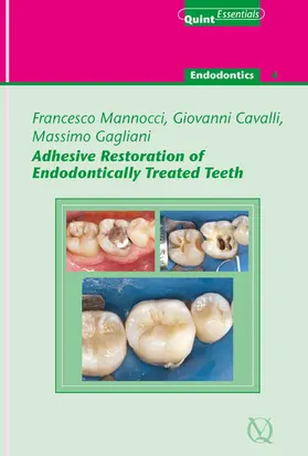 Mannocci / Gagliani / Cavalli |  Adhesive Restoration of Endodontically Treated Teeth | eBook | Sack Fachmedien