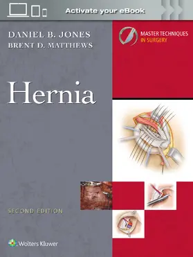 JONES / Matthews |  Master Techniques in Surgery: Hernia: Print + eBook with Multimedia | Buch |  Sack Fachmedien
