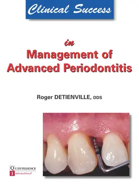 Detienville |  Clinical Success in Management of Advanced Periodontitis | eBook | Sack Fachmedien
