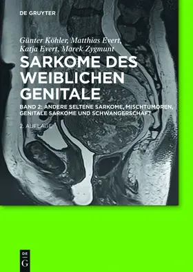 Köhler / Zygmunt / Evert |  Andere seltene Sarkome, Mischtumoren, genitale Sarkome und Schwangerschaft | Buch |  Sack Fachmedien