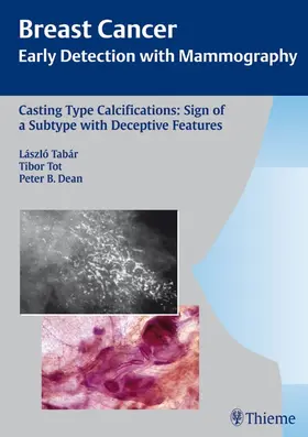 Tabar / Tot / Dean |  Casting-Type Calcifications: Sign of a Subtype with Deceptive Features | Buch |  Sack Fachmedien