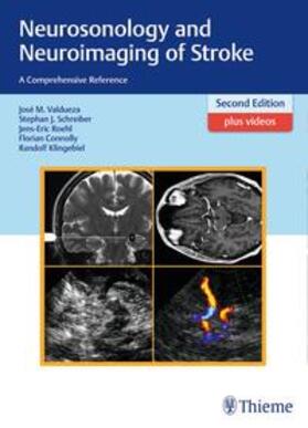 Valdueza / Schreiber / Röhl | Neurosonology and Neuroimaging of Stroke | Buch | sack.de
