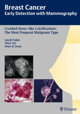 Tabar / Tot / Dean |  Breast Cancer: Early Detection with Mammography | eBook | Sack Fachmedien