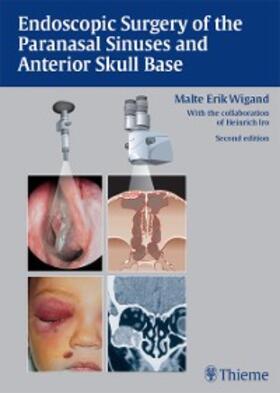 Wigand | Endoscopic Surgery of the Paranasal Sinuses and Anterior Skull Base | E-Book | sack.de