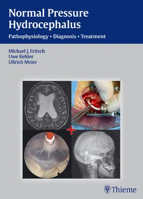 Fritsch / Meier / Kehler |  NPH - Normal Pressure Hydrocephalus | Buch |  Sack Fachmedien
