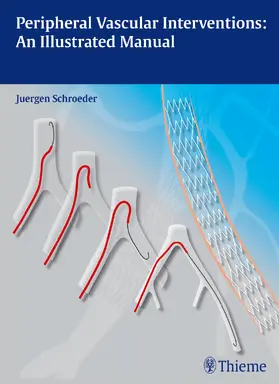 Schröder |  Peripheral Vascular Interventions: An Illustrated Manual | eBook | Sack Fachmedien