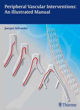 Schröder | Peripheral Vascular Interventions: An Illustrated Manual | E-Book | sack.de