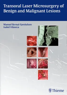 Bernal-Sprekelsen / Vilaseca | Transoral Laser Microsurgery of Benign and Malignant Lesions | E-Book | www.sack.de