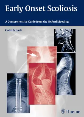 Nnadi |  Early Onset Scoliosis | Buch |  Sack Fachmedien