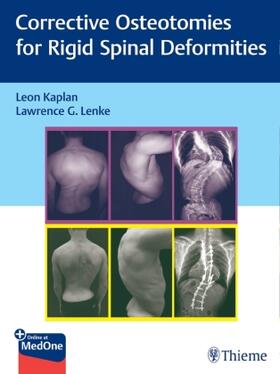 Kaplan / Lenke | Rigid Spine Deformities | Medienkombination | sack.de
