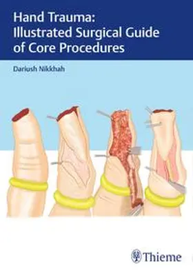 Nikkhah | Hand Trauma: Illustrated Surgical Guide of Core Procedures | Buch | 978-3-13-241426-6 | www.sack.de