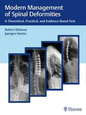 Dickson / Harms | Modern Management of Spinal Deformities | Buch | 978-3-13-243186-7 | www.sack.de