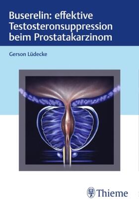 Lüdecke | Buserelin: effektive Testosteronsuppression beim Prostatakar | Buch | sack.de