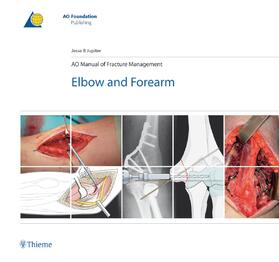 Jupiter | AO Manual of Fracture Management - Elbow and Forearm | E-Book | sack.de