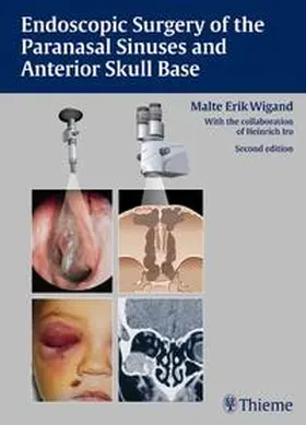 Wigand | Endoscopic Surgery of the Paranasal Sinuses and Anterior Skull Base | Buch | 978-3-13-749402-7 | sack.de