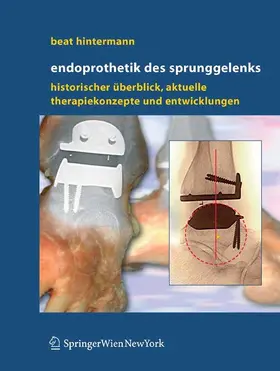 Hintermann |  Endoprothetik des Sprunggelenks | eBook | Sack Fachmedien