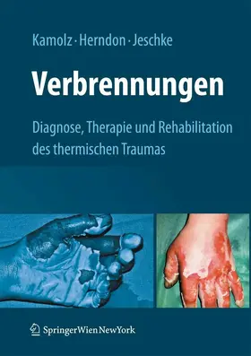 Kamolz / Herndon / Jeschke |  Verbrennungen | eBook | Sack Fachmedien