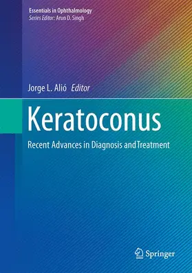 Alió |  Keratoconus | Buch |  Sack Fachmedien