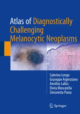 Longo / Argenziano / Lallas | Atlas of Diagnostically Challenging Melanocytic Neoplasms | E-Book | www.sack.de