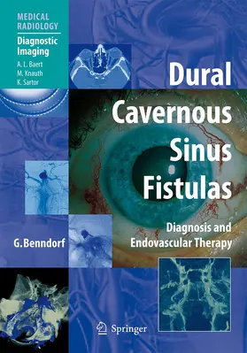 Benndorf |  Dural Cavernous Sinus Fistulas | Buch |  Sack Fachmedien