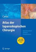Carus |  Operationsatlas Laparoskopische Chirurgie | eBook | Sack Fachmedien