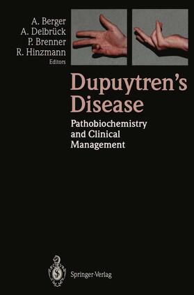 Berger / Hinzmann / Delbrück | Dupuytren¿s Disease | Buch | 978-3-540-57239-8 | sack.de