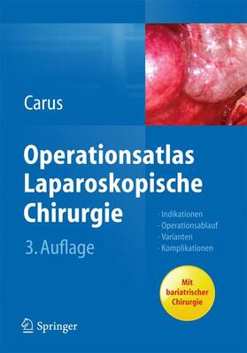 Carus | Carus, T: Operationsatlas Laparoskopische Chirurgie | Buch | 978-3-642-31245-8 | sack.de