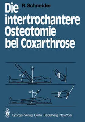 Schneider |  Die intertrochantere Osteotomie bei Coxarthrose | eBook | Sack Fachmedien