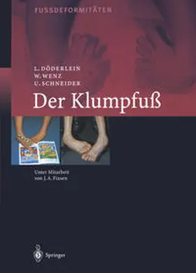 Döderlein / Wenz / Schneider |  Der Klumpfuss | eBook | Sack Fachmedien
