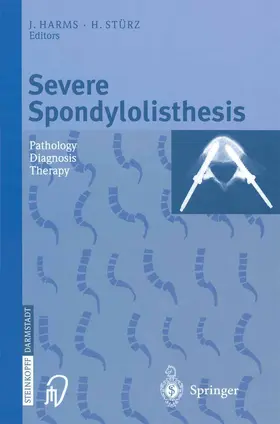 Harms / Stürz |  Severe Spondylolisthesis | Buch |  Sack Fachmedien