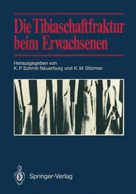 Schmit-Neuerburg / Stürmer |  Die Tibiaschaftfraktur beim Erwachsenen | eBook | Sack Fachmedien
