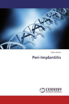 Kumar |  Peri-Implantitis | Buch |  Sack Fachmedien