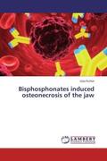 Kumar |  Bisphosphonates induced osteonecrosis of the jaw | Buch |  Sack Fachmedien