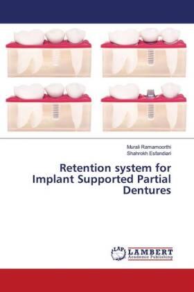 Ramamoorthi / Esfandiari | Retention system for Implant Supported Partial Dentures | Buch | 978-3-659-78631-0 | sack.de