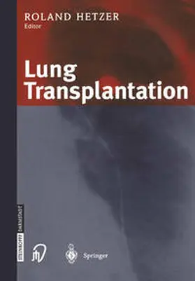 Hetzer |  Lung Transplantation | eBook | Sack Fachmedien