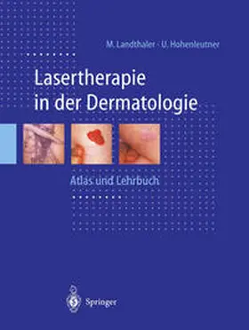 Landthaler / Hohenleutner |  Lasertherapie in der Dermatologie | eBook | Sack Fachmedien
