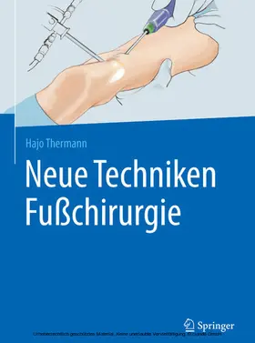 Thermann |  Neue Techniken Fußchirurgie | eBook | Sack Fachmedien