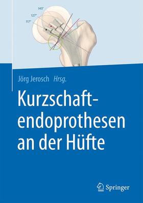 Jerosch | Kurzschaftendoprothesen an der Hüfte | Buch | 978-3-662-52743-6 | sack.de