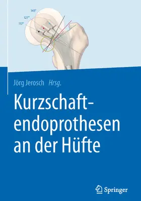 Jerosch | Kurzschaftendoprothesen an der Hüfte | E-Book | www.sack.de