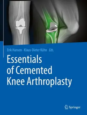 Kühn / Hansen |  Essentials of Cemented Knee Arthroplasty | Buch |  Sack Fachmedien
