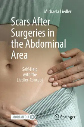 Liedler |  Scars After Surgeries in the Abdominal Area | Buch |  Sack Fachmedien