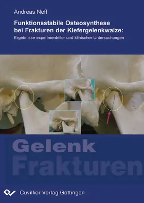 Neff |  Funktionsstabile Osteosynthese bei Frakturen der Kiefergelenkwalze | eBook | Sack Fachmedien